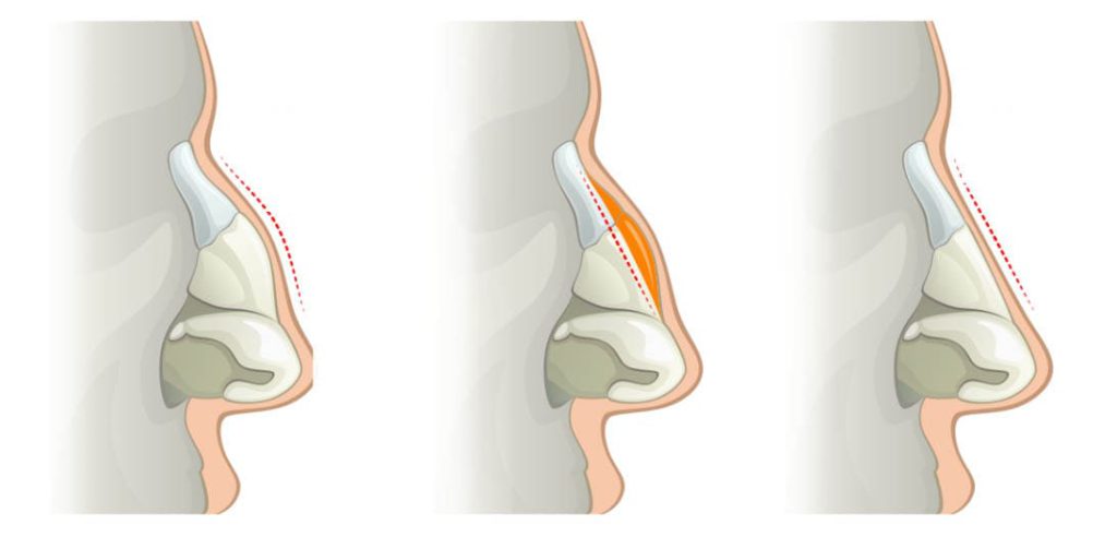 image de la structure osseuse d'un nez