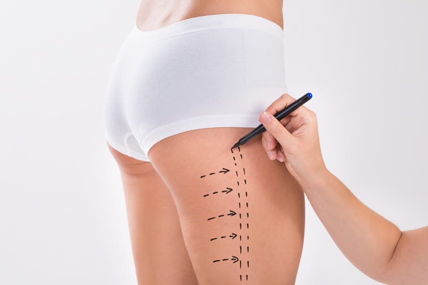 Tracé d'un chirurgien sur les fesses d'une patiente