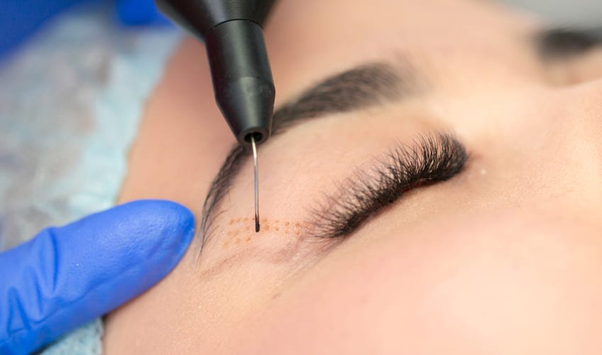 Technique de blépharoplastie par laser
