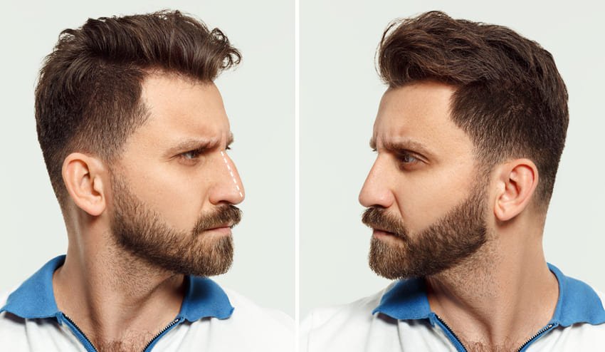 Photo d'un homme après une rhinoplastie