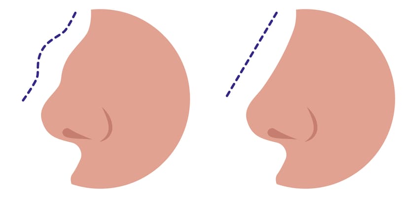 Supprimer la bosse sur le nez
