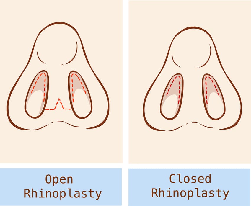 rhinoplastie ouverte et fermée