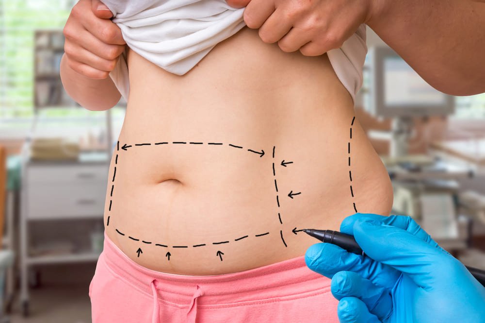 Tracés pour une abdominoplastie
