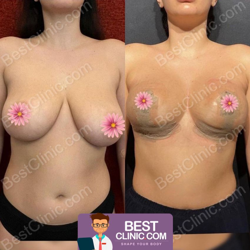 reduction mammaire avant après en Turquie