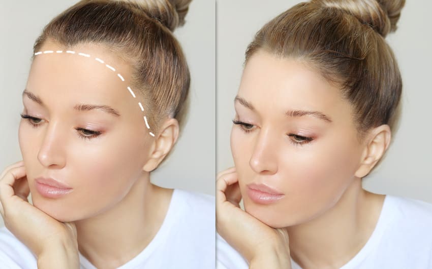 Simulation abaissement de la ligne frontale chez la femme